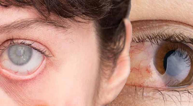 bệnh lý đục thuỷ tin thể