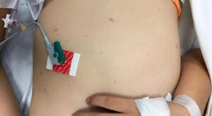 Bệnh viện TP Thủ Đức, TP HCM tiếp nhận và điều trị các trường hợp trẻ mắc bệnh não mô cầu