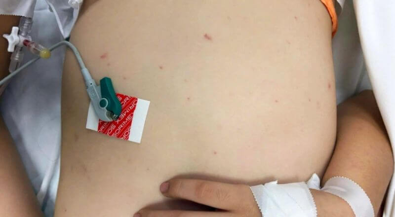 Bệnh viện TP Thủ Đức, TP HCM tiếp nhận và điều trị các trường hợp trẻ mắc bệnh não mô cầu