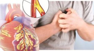 Các dấu hiệu nhận diện sớm bệnh động mạch vành
