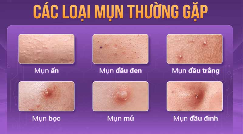 Các loại mụn lưng thường gặp
