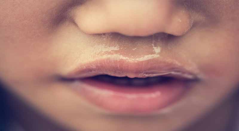 Chảy nước mũi trong là gì?