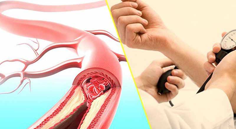 Huyết áp tăng đột ngột do đâu?