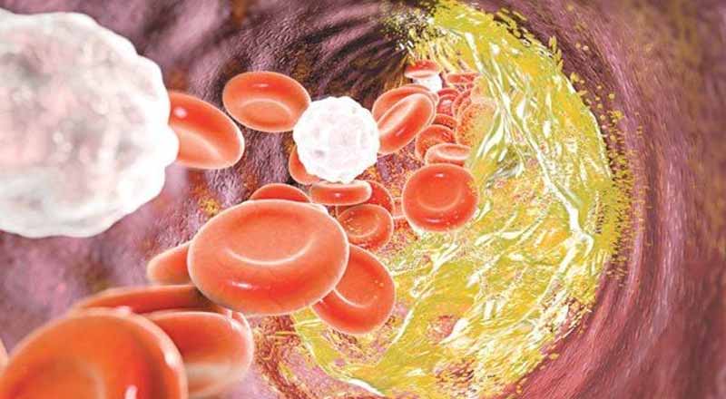 Rối loạn lipid máu: Hướng dẫn chẩn đoán và điều trị 13 Kiểm tra mỡ máu cao bằng xét nghiệm