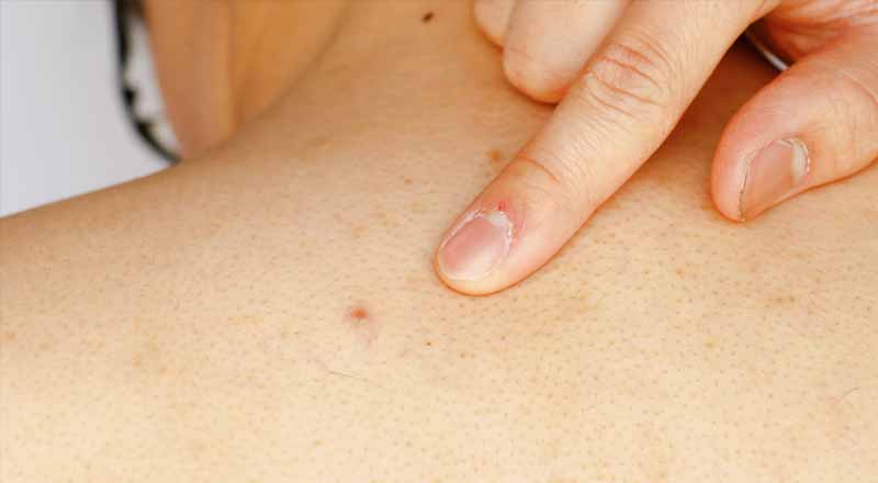 Liệu mụn lưng có tự lành được không?