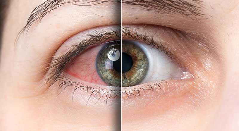 mắt mờ như có màng che và cảnh báo bệnh lý