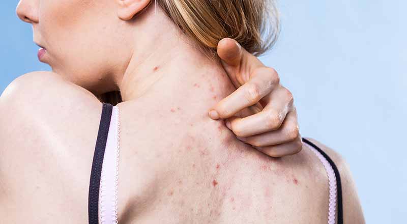 Mụn lưng hình thành do những nguyên nhân nào?