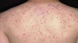 Mụn lưng xuất hiện do đâu và làm sao để trị dứt điểm