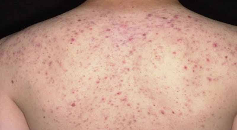 Mụn lưng xuất hiện do đâu và làm sao để trị dứt điểm