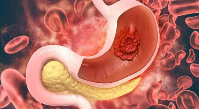 Nhận biết bệnh dạ dày qua các triệu chứng