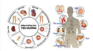 Phương pháp kiềng ba chân giúp kiểm soát Đái Tháo Đường an toàn