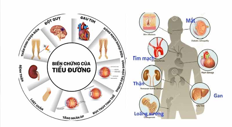 Phương pháp kiềng ba chân giúp kiểm soát Đái Tháo Đường an toàn