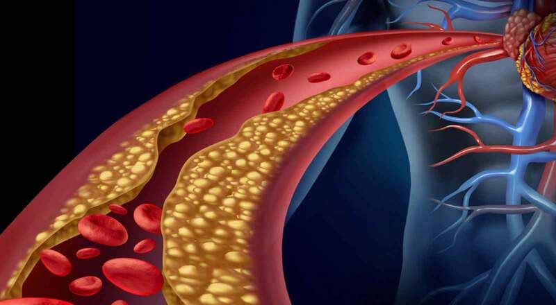 Rối loạn lipid máu: Hướng dẫn chẩn đoán và điều trị