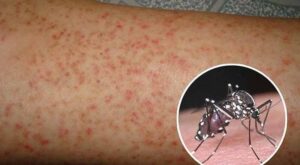 Sốt xuất huyết có lây không? Cách phòng tránh hiệu quả