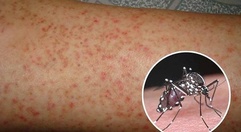 Sốt xuất huyết có lây không? Cách phòng tránh hiệu quả