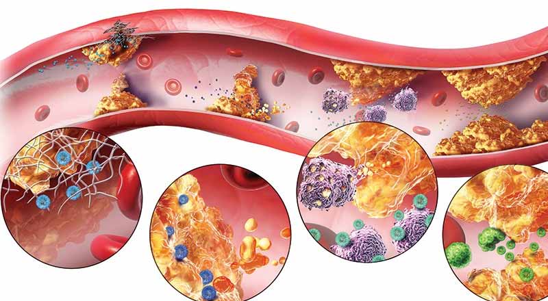Rối loạn lipid máu: Hướng dẫn chẩn đoán và điều trị 10 Triệu chứng của mỡ máu cao